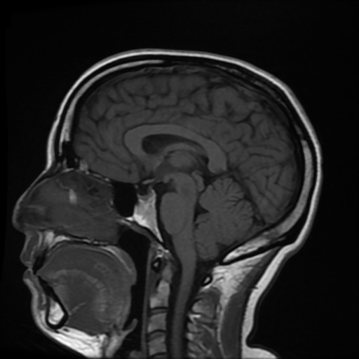 Mid-sagittal MRI scan